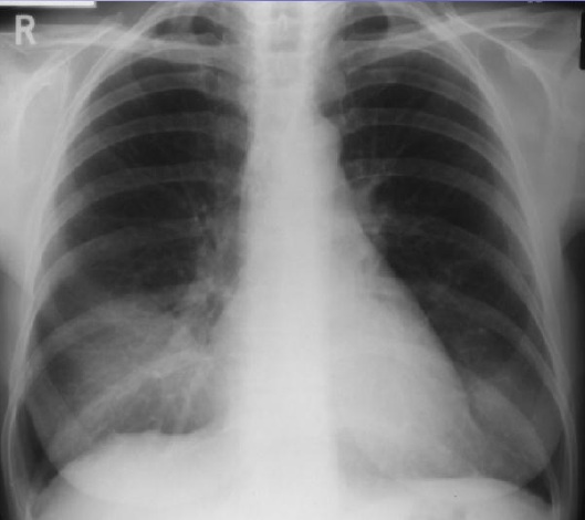 Cxr Aspiration Pneumona